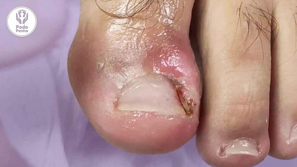 Bem encravada e no retorno ainda tinha unha  – Podologia Podo Penha