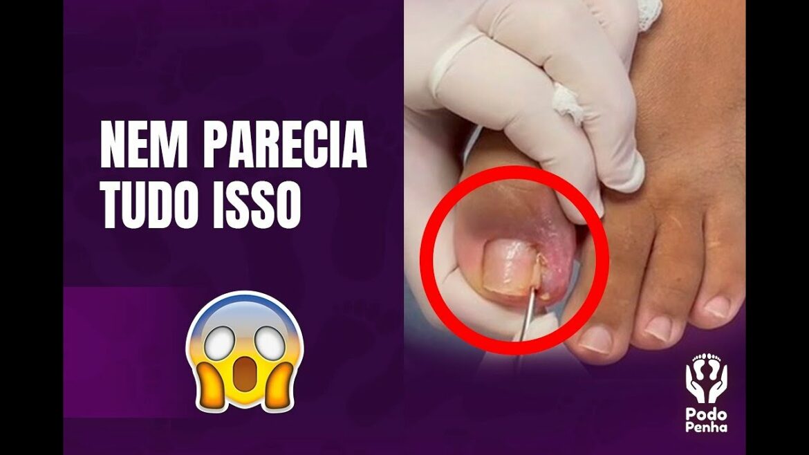 PARA QUEM GOSTA DE UNHA BEM ENCRAVADA – PODOLOGIA PODO PENHA