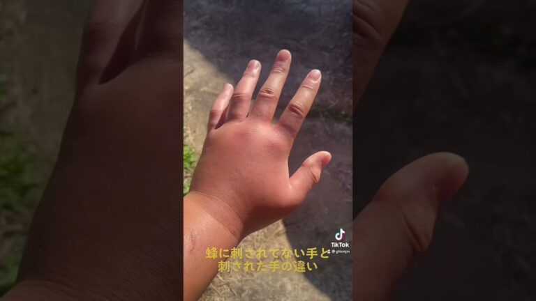 蜂に刺された