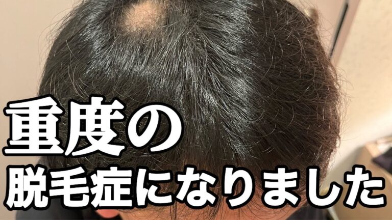 [円形脱毛症] 発症から12年　症状全て見せます　#円形脱毛症  #自律神経失調症  #適応障害  #パニック障害