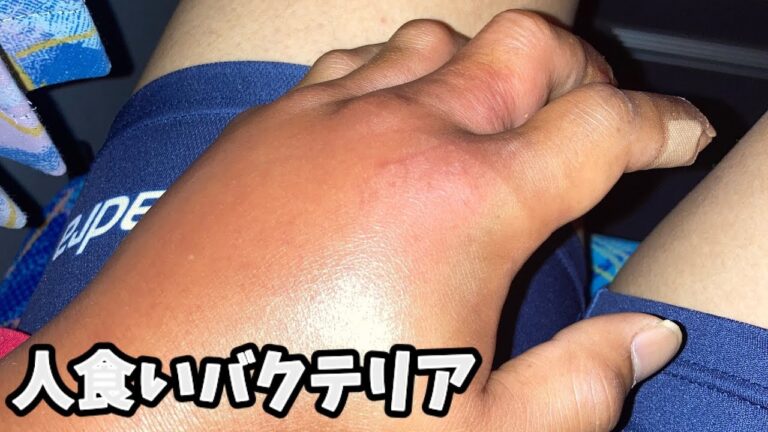 その後の検査で、人食いバクテリアに感染してました