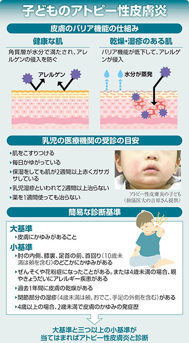 子どものアトピー性皮膚炎…早期治療へ　学会が手引