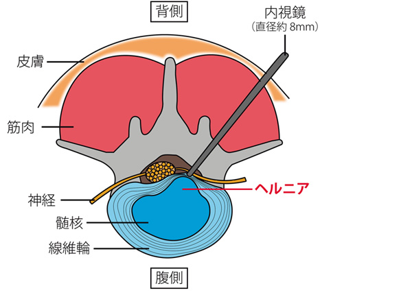 FESS（完全内視鏡下脊椎手術）のイメージ図