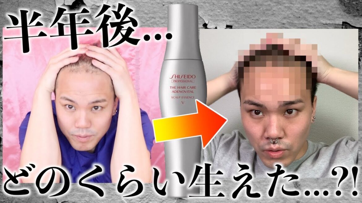 【延長戦】半年間の育毛結果はいかに...?!【アデノバイタル】