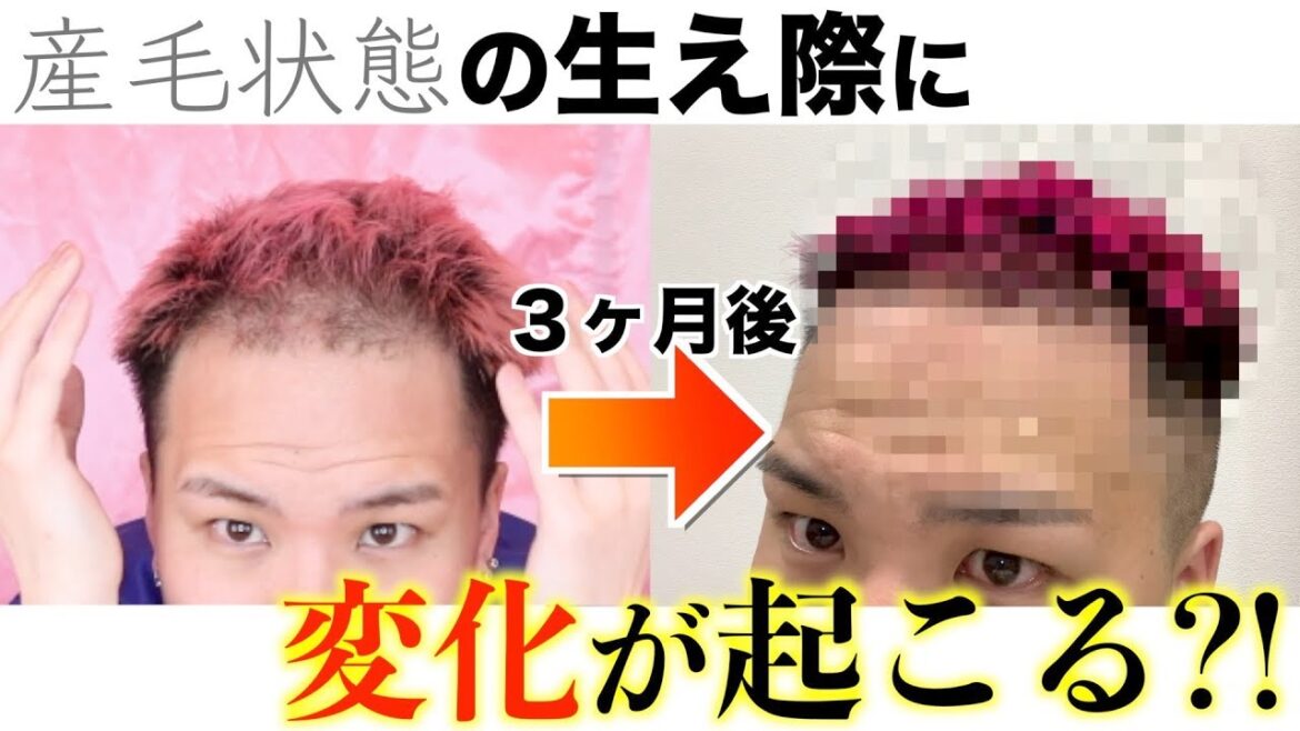 【後編】３ヶ月育毛剤を使ったら生え際に変化が...【アデノバイタル】