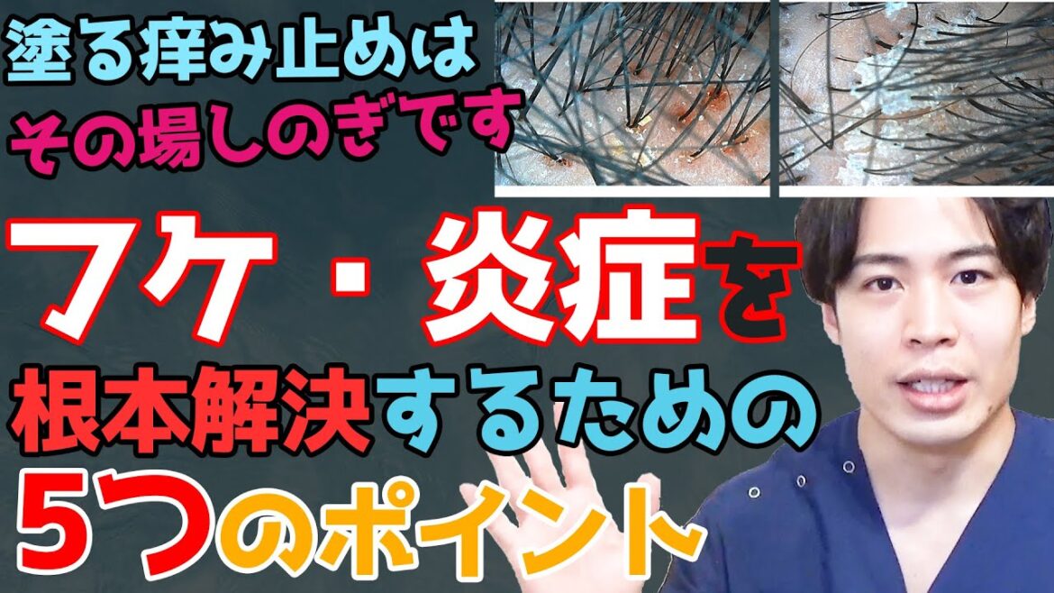 大量に出るフケをなくすには?乾燥したフケに特化した5つの対策とは? 大量に出るフケをなくすには?乾燥したフケに特化した5つの対策とは?