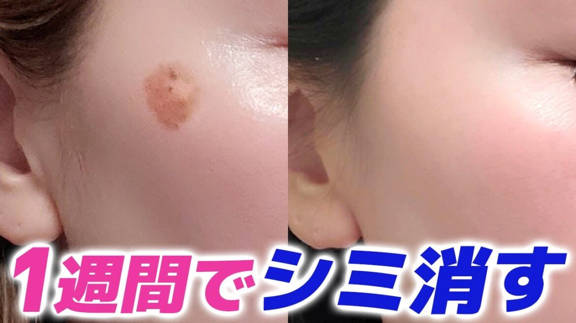 【実話】私が1週間でシミを取った方法【シミ消す方法】 【実話】私が1週間でシミを取った方法【シミ消す方法】