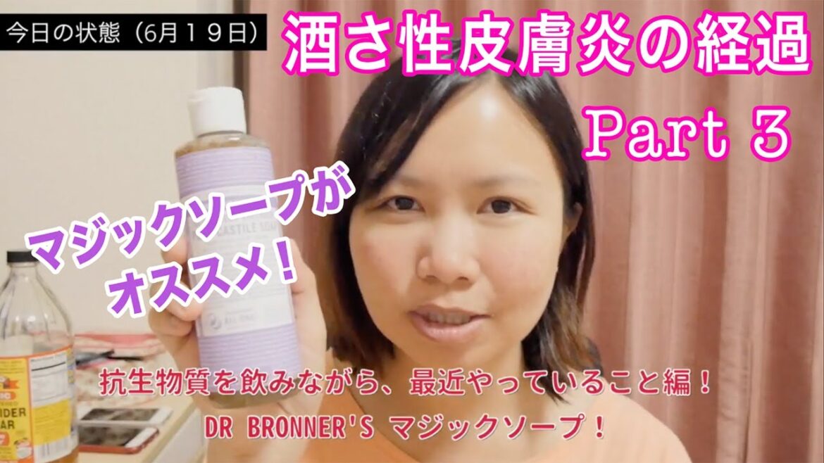 酒さ性皮膚炎の話　治療レポート③ Dewi Nikki