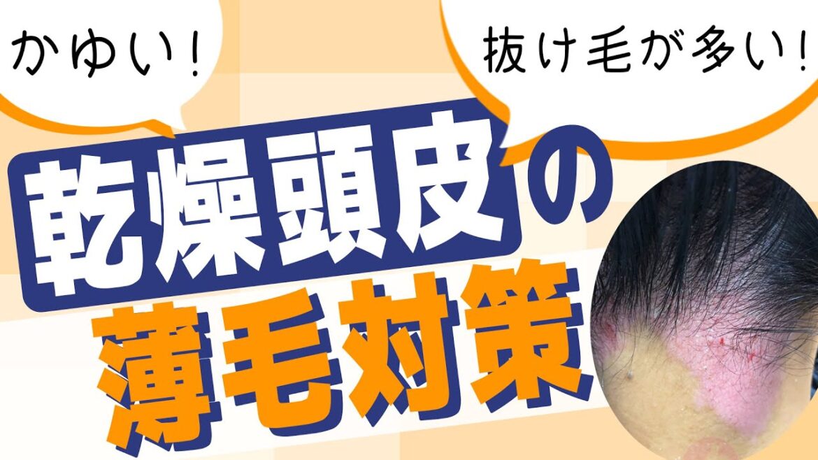 かゆい!抜け毛多い!乾燥頭皮の薄毛対策! かゆい!抜け毛多い!乾燥頭皮の薄毛対策!