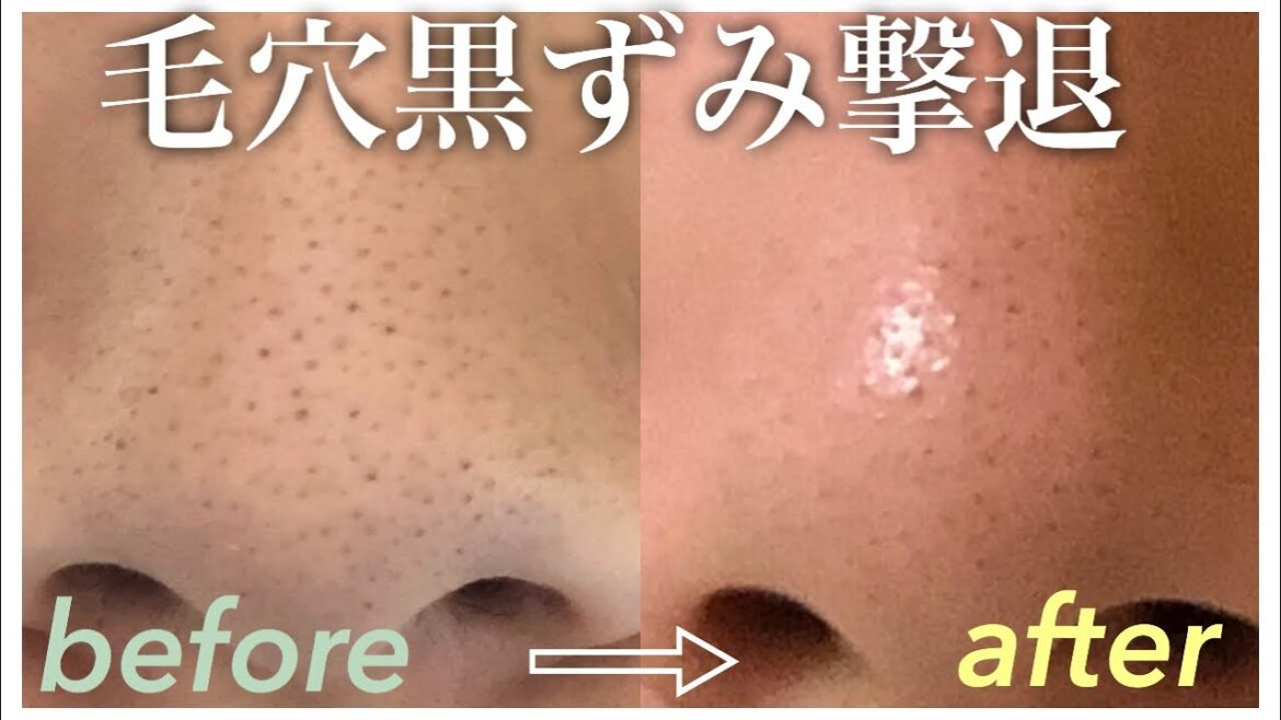 【イチゴ鼻撃退】鼻の黒ずみケアご紹介します！コンプレックスだった頑固な鼻の黒ずみをかなりマシにしました！【スキンケア】