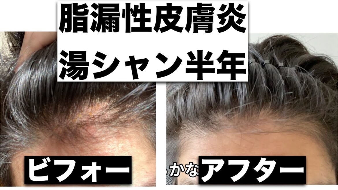 脂漏性皮膚炎シャンプー辞めて半年後のビフォーアフターがこちら 脂漏性皮膚炎シャンプー辞めて半年後のビフォーアフターがこちら