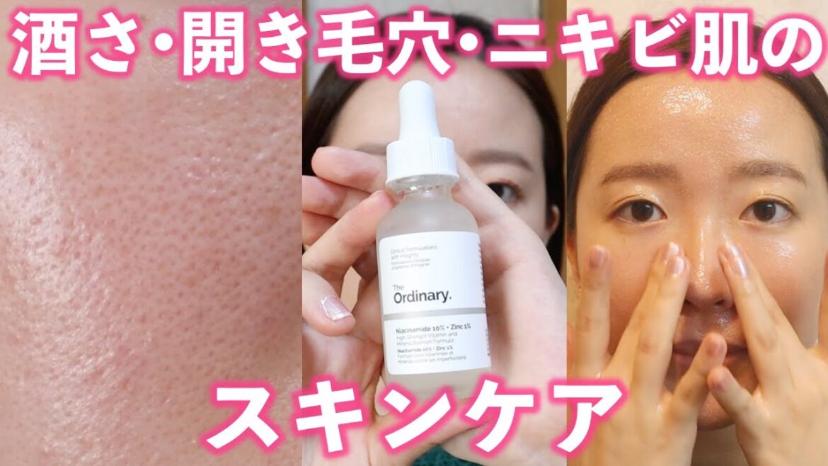 【すり鉢毛穴】酒さ•開き毛穴•ニキビ肌の私の最近のスキンケア!おすすめの商品もご紹介します (開き毛穴/いちご鼻/混合肌/ニキビ跡/肌の赤み) 【すり鉢毛穴】酒さ•開き毛穴•ニキビ肌の私の最近のスキンケア!おすすめの商品もご紹介します (開き毛穴/いちご鼻/混合肌/ニキビ跡/肌の赤み)