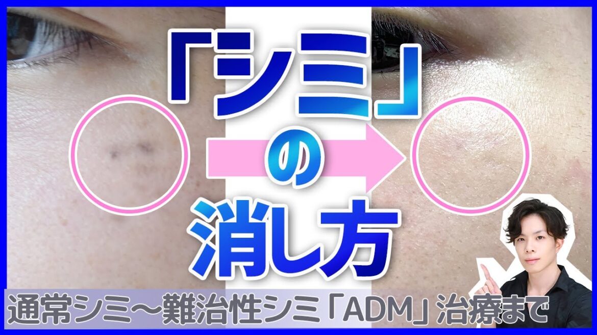 専門家が解説！シミの消し方【一般的なシミから難治性シミ『後天性真皮メラノサイトーシス（ADM）』治療まで】ニキビ痕・肝斑・そばかす・老人性色素斑の対策も！