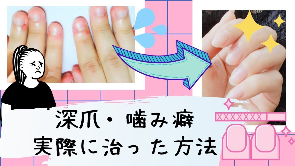 【実体験】深爪を治す方法【サロン・セルフ深爪矯正】 【実体験】深爪を治す方法【サロン・セルフ深爪矯正】