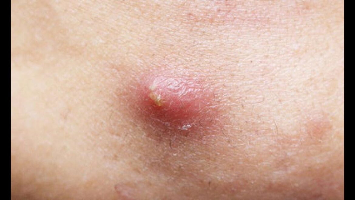 夏にできがちな「お尻ニキビ」を治す6つの方法