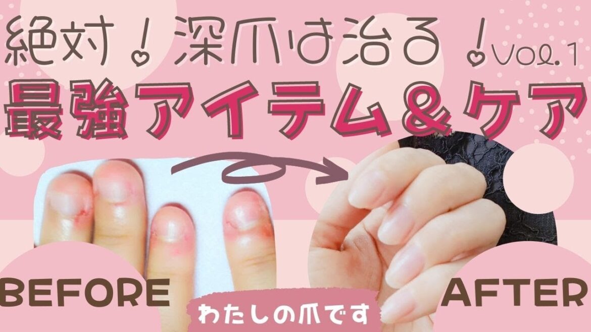 【2022年最新】絶対深爪を治す！最強アイテム＆ケア【深爪矯正・爪を伸ばす方法】