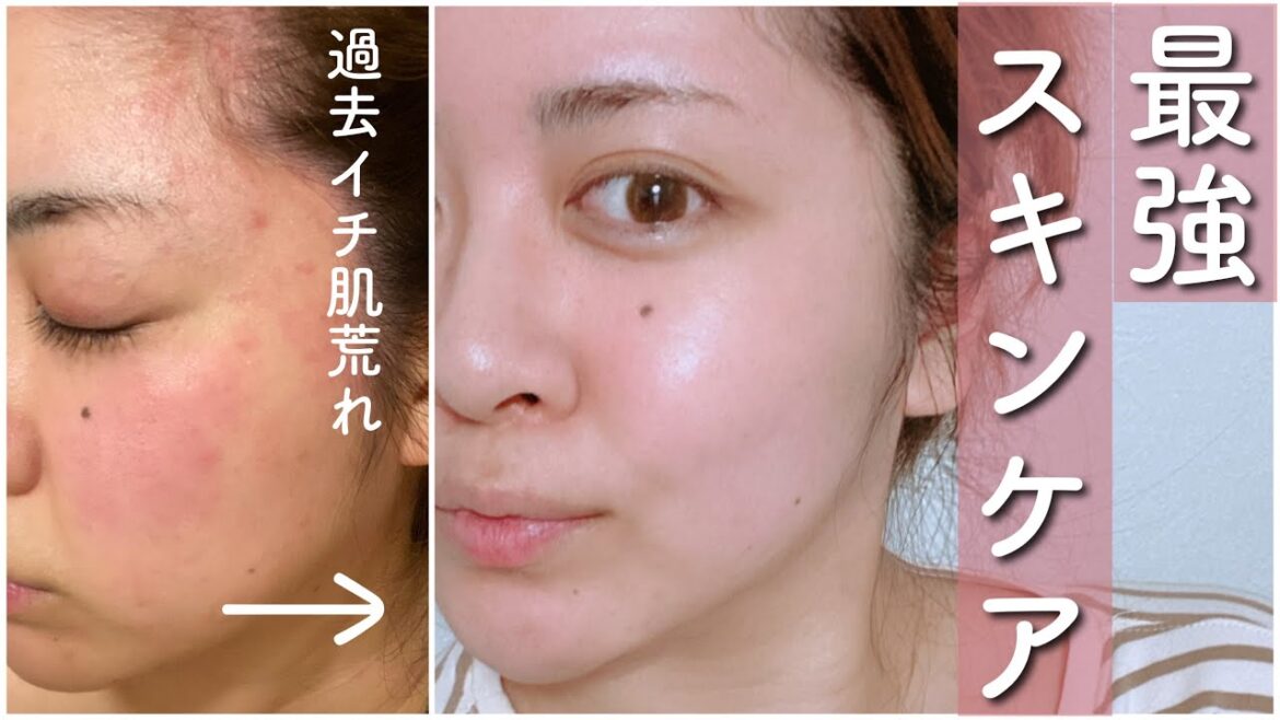 過去一荒れた肌を短期間で治したスキンケア方法🌿ニキビ｜毛穴｜赤み