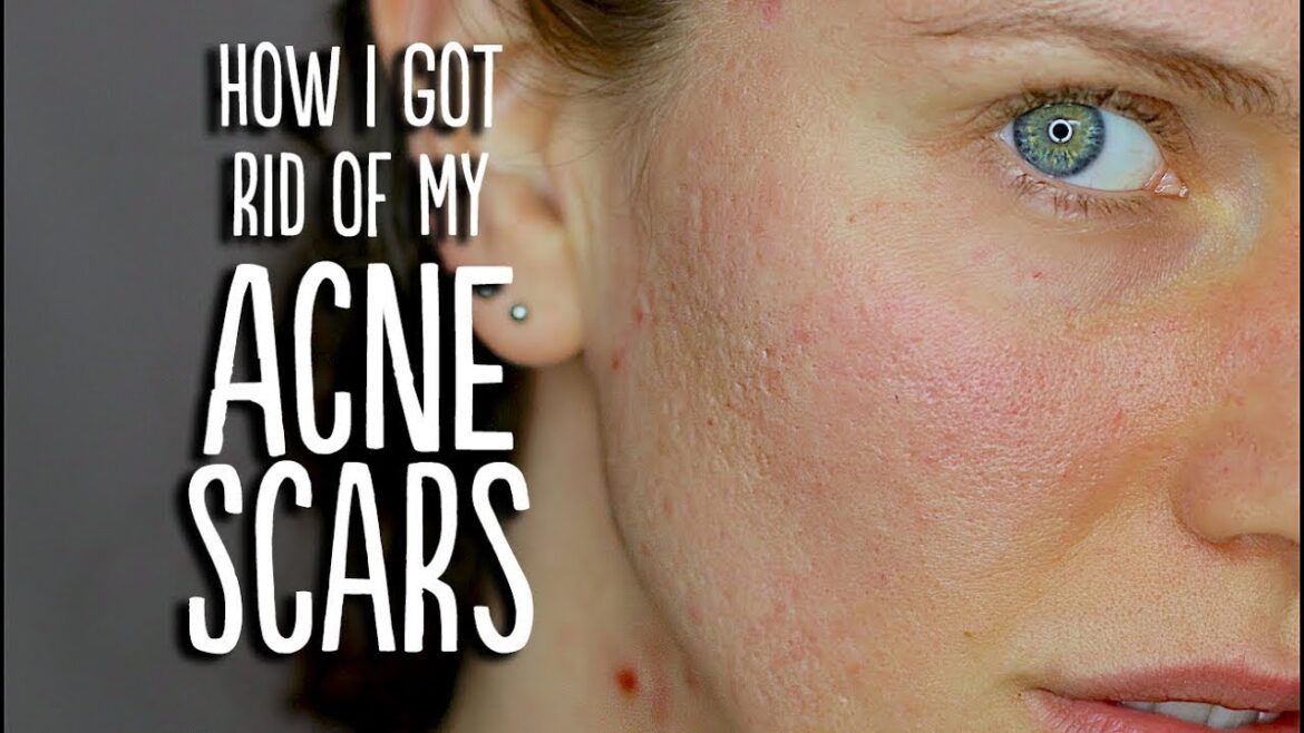 にきび+傷跡の更新(私が私のにきびの傷跡を取り除く方法) にきび+傷跡の更新(私が私のにきびの傷跡を取り除く方法)