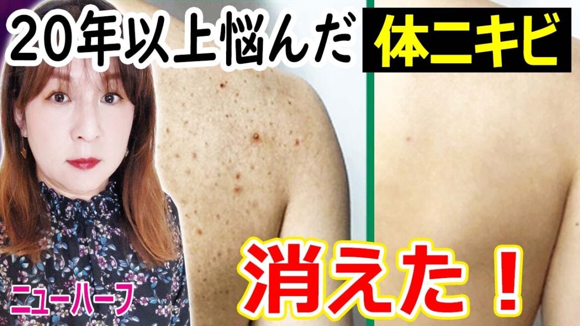 私はこのボディソープで20年以上悩んだ体ニキビが消えた（コスパ＆肌触り最高）
