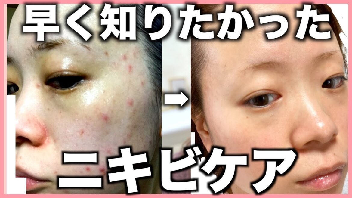 【ニキビ克服方法】本当に悩んでいる方へ。あらゆる方法を試してやっと見つけたニキビケア