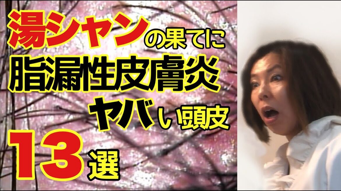 湯シャン主義のあなたの頭皮マラセチアの温床になってない?薄毛の原因もしかしたら脂漏性皮膚炎 かも!?湯シャンで済ますとこうなる!かもしれない画像13選 湯シャン主義のあなたの頭皮マラセチアの温床になってない?薄毛の原因もしかしたら脂漏性皮膚炎 かも!?湯シャンで済ますとこうなる!かもしれない画像13選