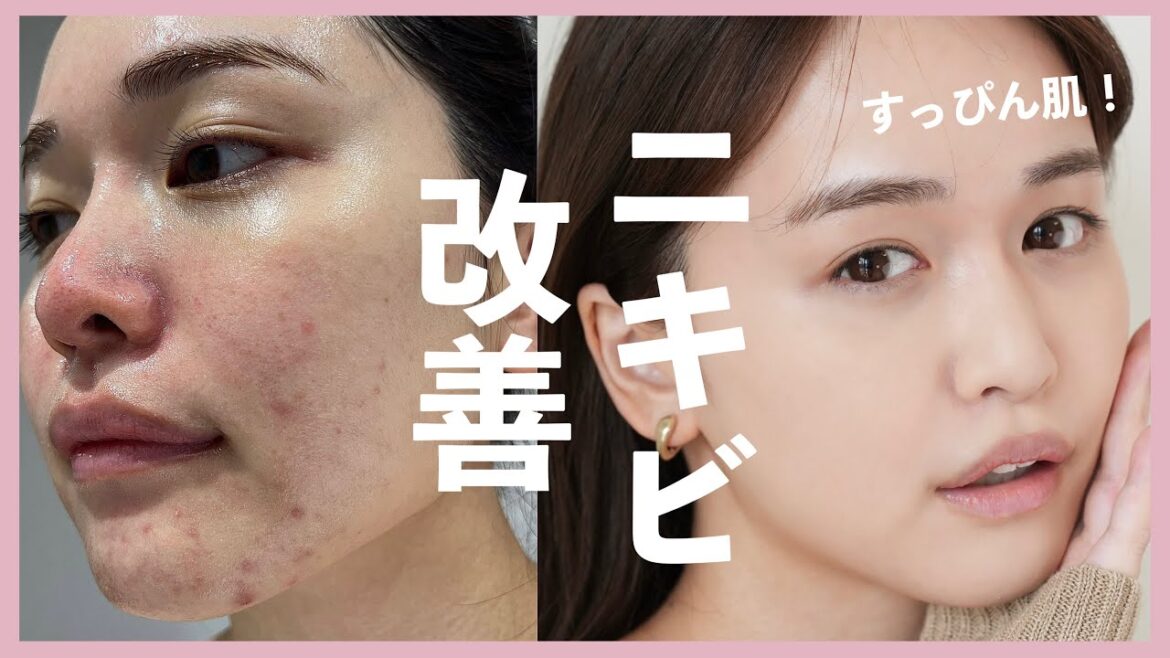 【すっぴん】ニキビ改善した方法まとめました♡ 【すっぴん】ニキビ改善した方法まとめました♡