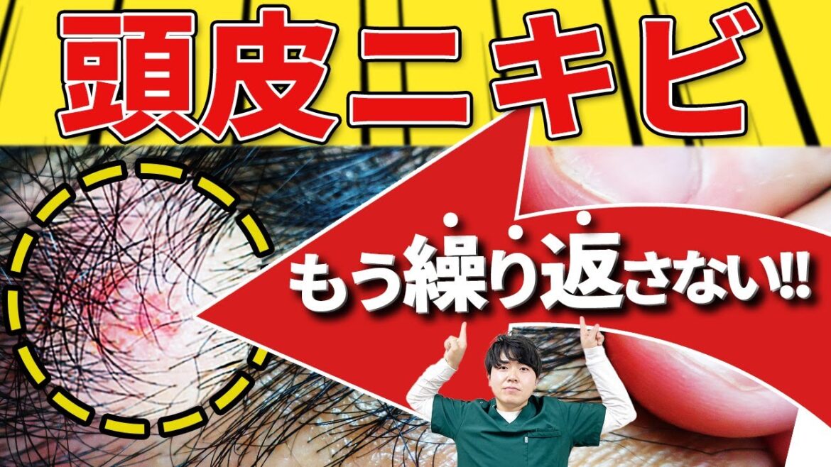 【これ一本で解決！】しつこ～い「頭皮ニキビ」これで撃退！！原因と対策まで徹底解説