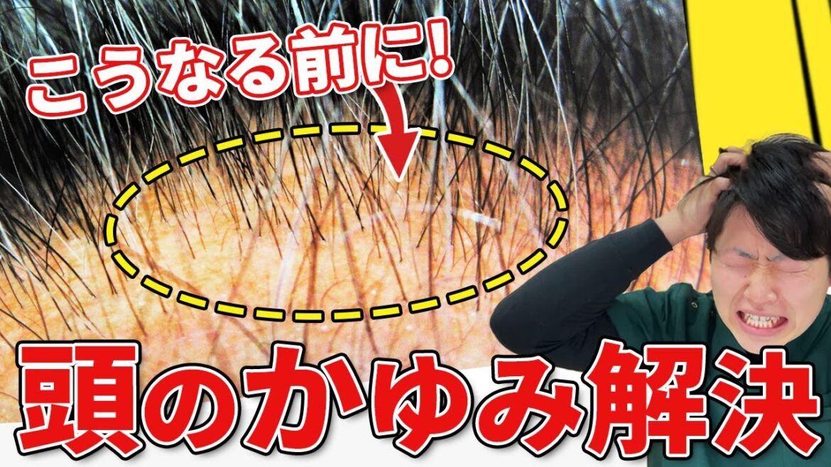 【逆効果】痒くなるシャンプーの仕方！！