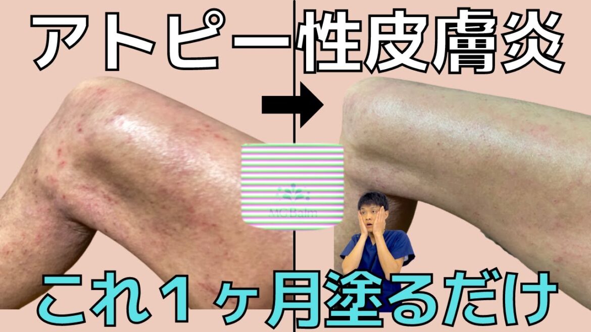 【アトピー性皮膚炎 塗り薬】ほぼ100％効果あり！最新版アトピー治し方”マグネシウムスキンケア”