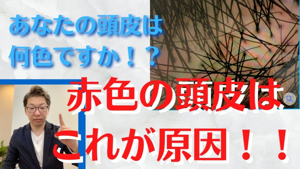 頭皮の色！赤色やピンク色の方いませんか！？