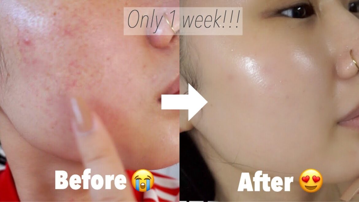 たったの１週間でひどい赤みただれ、カサカサ肌からツヤツヤ肌に激変！！冬の乾燥性敏感肌！スキンケア全取っ替え救世主たち紹介！| Amibeauty.jp