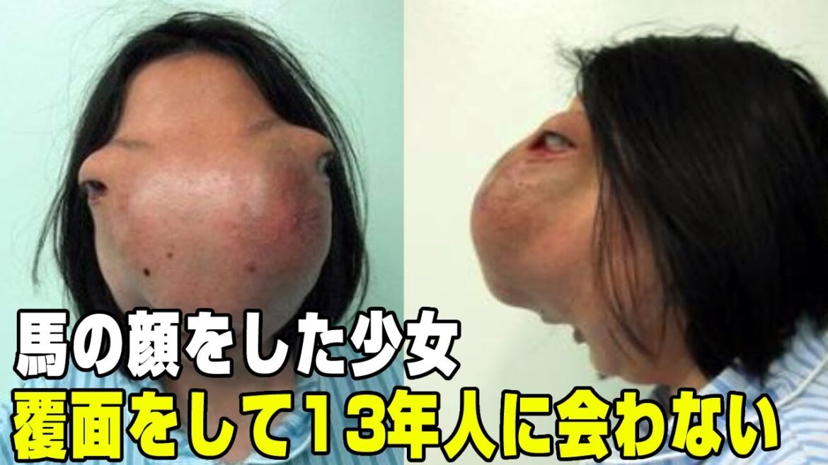 馬の顔をした少女が、13年間マスクに身を隠してきた、知られざる物語。#雑学 #事件 #奇病 #実話 馬の顔をした少女が、13年間マスクに身を隠してきた、知られざる物語。#雑学 #事件 #奇病 #実話
