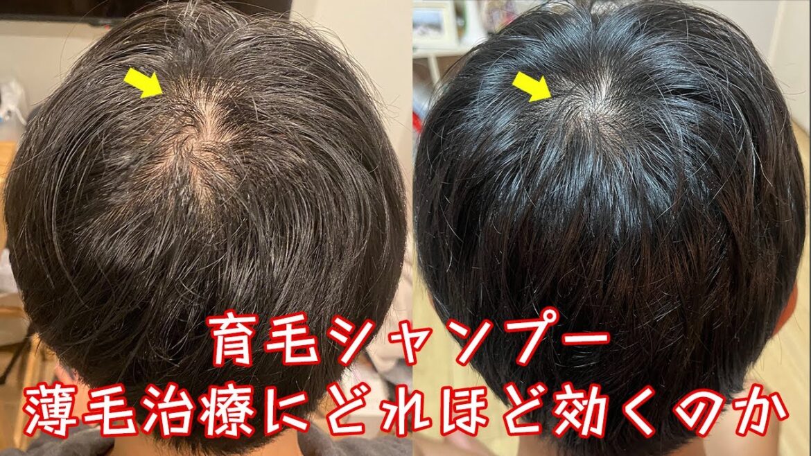 【男女】薄毛治療にオススメの育毛シャンプーはこれです。