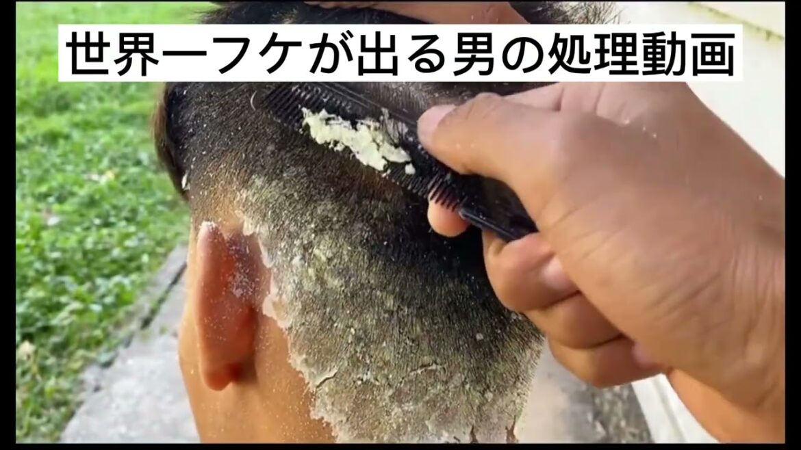 世界一フケが出る男のディープクリーニング動画　dandruff video treatment
