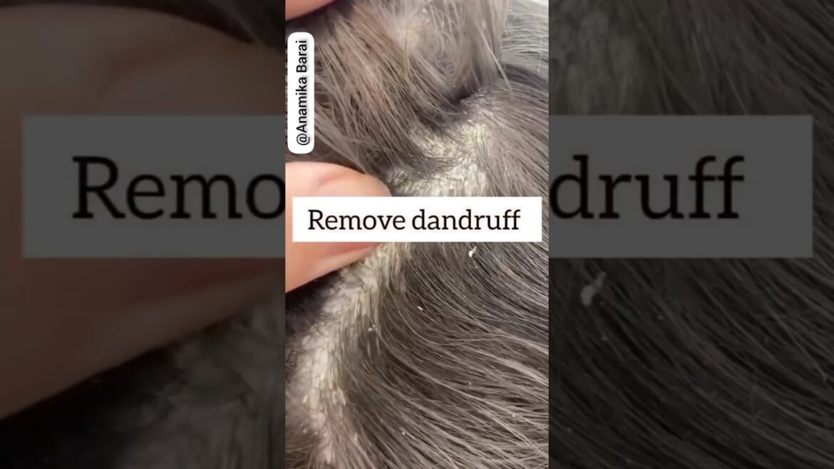 💯Remove Dandruff Just In 1 Wash🔥#dandruff #haircare #hairfall #hairgrowth #viral #1m #short #shorts