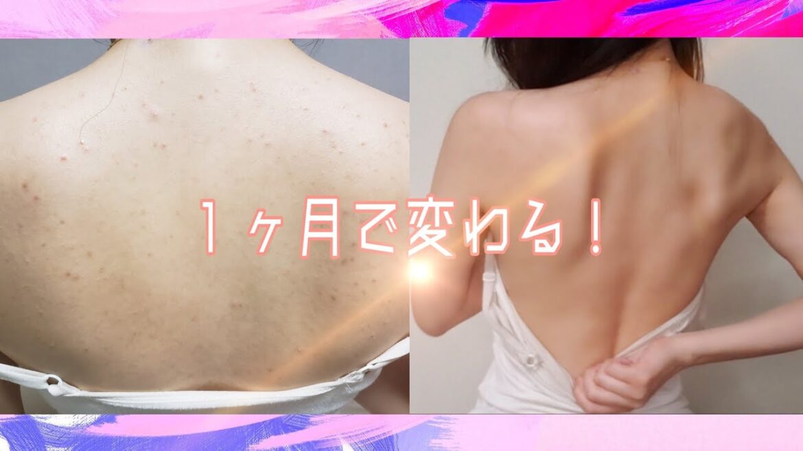 【背中ニキビ】最速で効果が出る！自宅で出来るニキビ・ニキビ跡の治し方