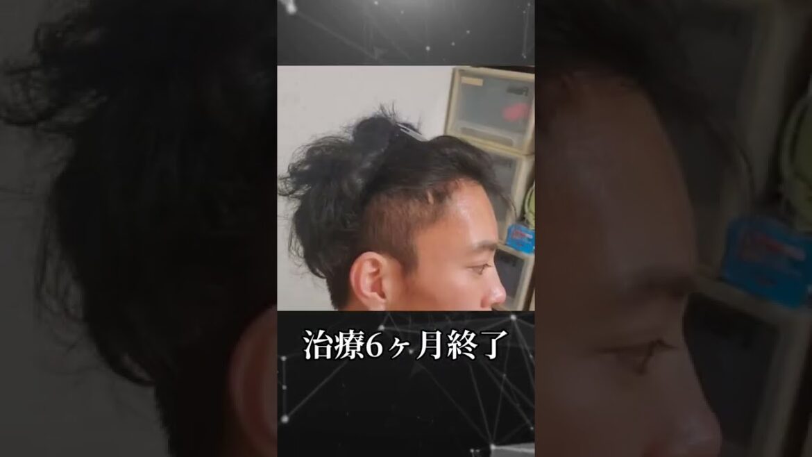 【AGA】薄毛治療6ヶ月のビフォーアフターが凄い件 #shorts