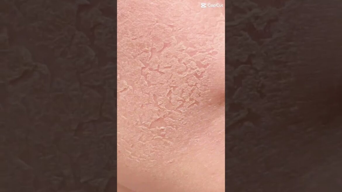 頬の開き毛穴、凸凹した肌に悩んでハーブピーリングを繰り返していた過去…今ではファンデーション不要なフラットなお肌になりました✨