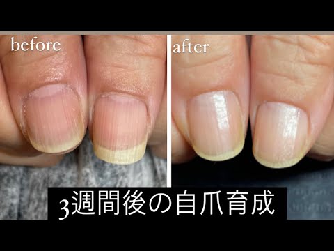 【ショートムービー】縦筋・縦割れ・爪の色が悪くて悩んでる方へ 病気でも3週間で自爪育成 【ショートムービー】縦筋・縦割れ・爪の色が悪くて悩んでる方へ 病気でも3週間で自爪育成