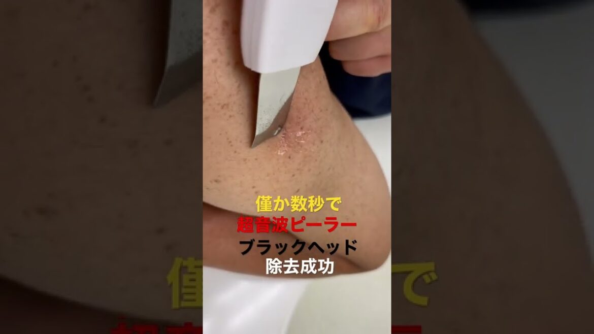 『にゅるにゅる角栓』1ブラックヘッドを僅か数秒で除去成功（超音波ピーラー）