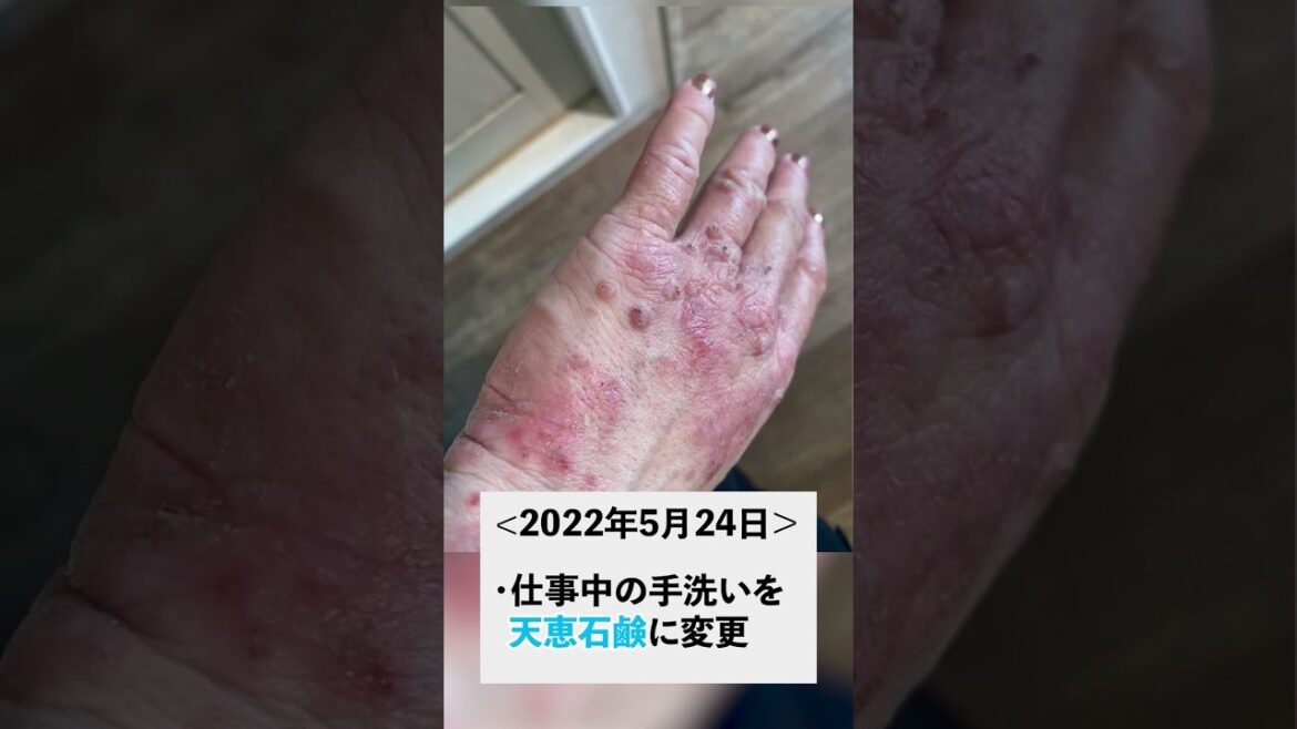 無添加石鹸で肌荒れ改善した経過を大公開【天恵石鹸】