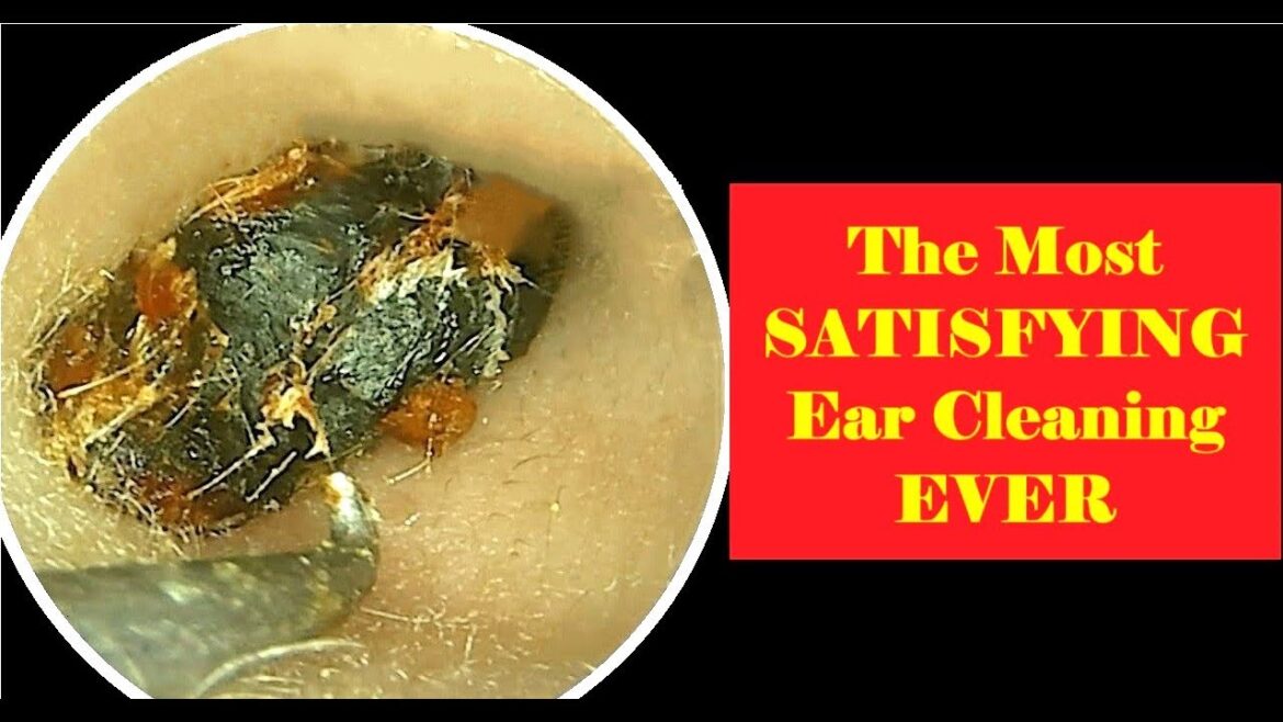 The Most SATISFYING Ear Cleaning EVER | Tr. Hoan - TER