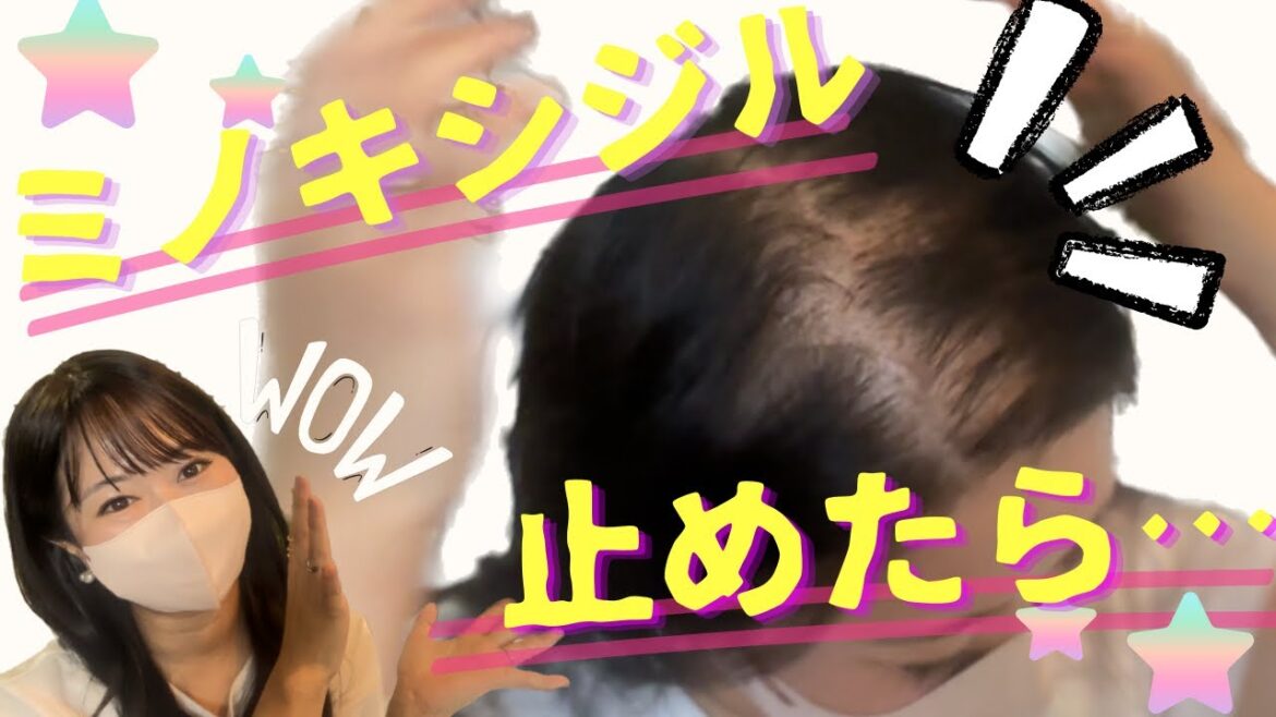ミノキシジル止めたら… ミノキシジル止めたら…