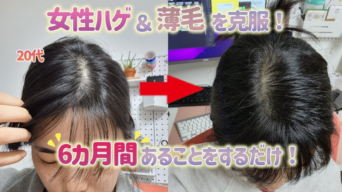 【悩んでる方必見】20代女性ハゲ＆薄毛からの克服ストーリ！育毛成功の秘密も公開！