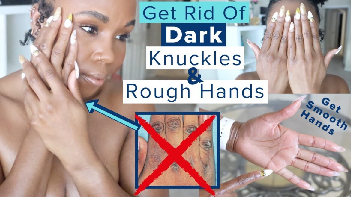 Get Rid of Dark Knuckles & ROUGH Hands | No More Hyperpigmentation, Dry Hands & Acanthosis Nigricans Get Rid of Dark Knuckles & ROUGH Hands | No More Hyperpigmentation, Dry Hands & Acanthosis Nigricans