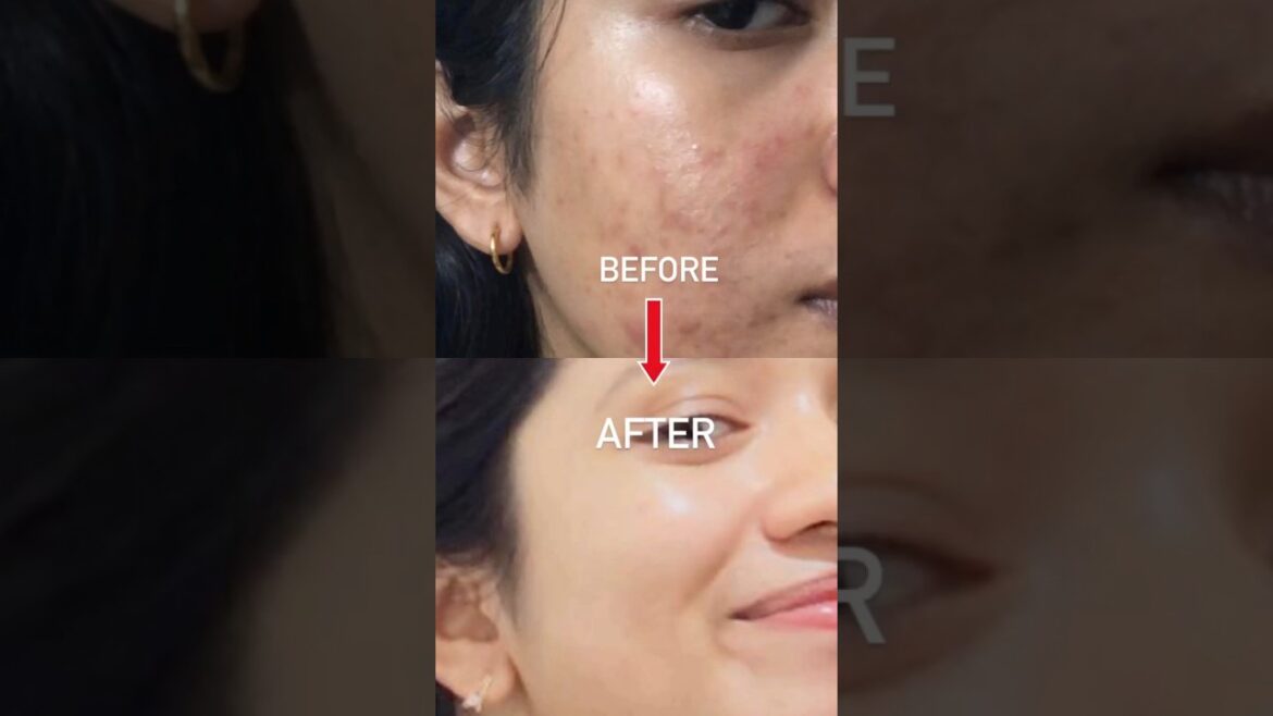 1 PRODUCT Changed ACNE TO CLEAR SKIN JOURNEY🤍🥺With in 2 month#acne