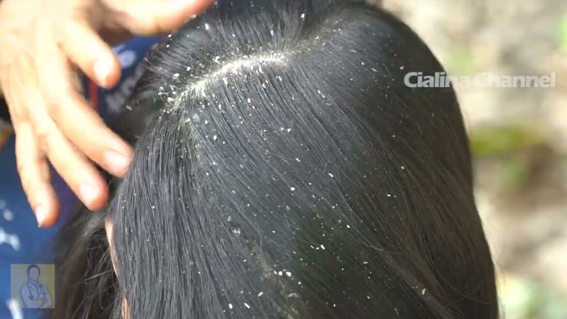 Satisfying Extremely Damaged Dandruff Scratching 2496