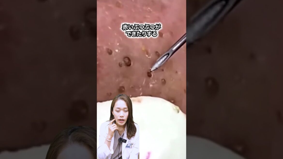 【角栓除去】黒いにゅるにゅるを除去！？ #shorts