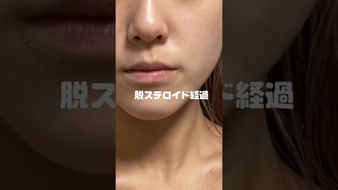 脱ステロイド1年の経過🫢　　　　　　　　　　　　あなたも必ず良くなります.ᐟ　　　　　#脱ステロイド #アトピー性皮膚炎 #アトピー改善 #アトピー#脱ステ