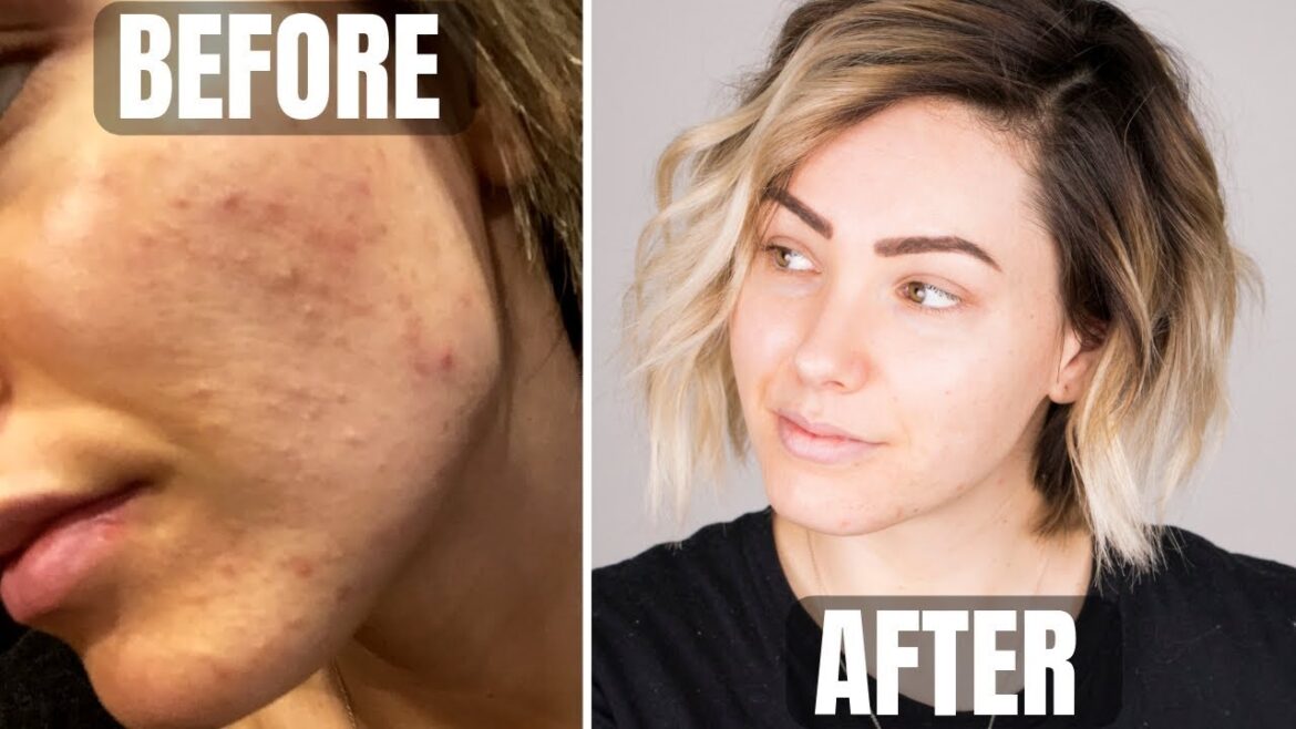 SKINCARE ROUTINE || acne prone skin